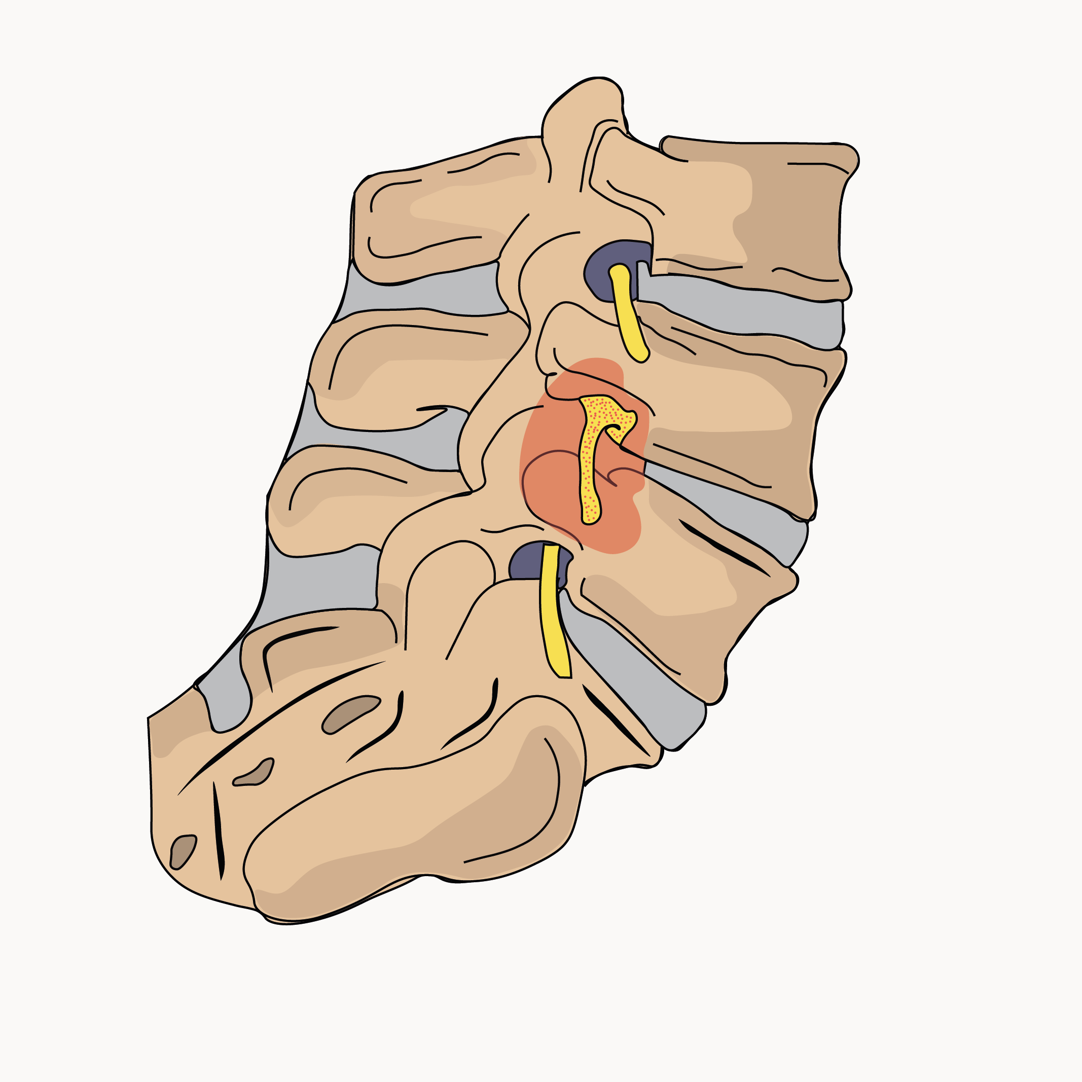 Kanal Darlığı ( Spinal stenozis )